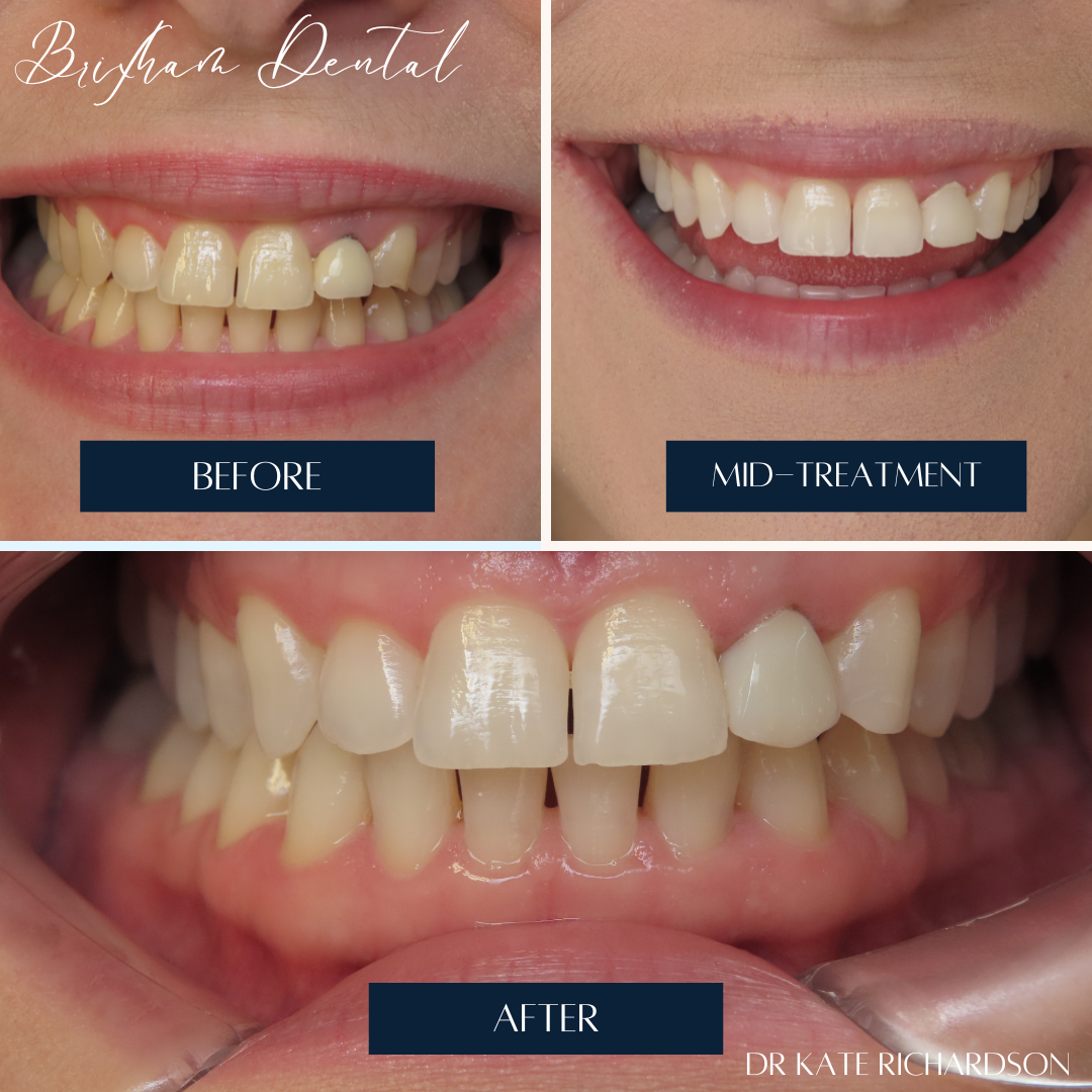 Before and after dental treatment - Anneke