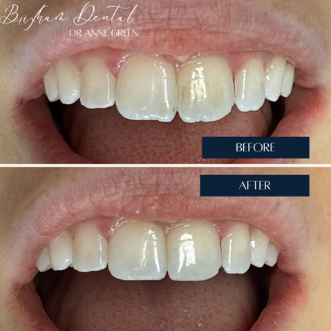 Before and after teeth whitening - Case 1