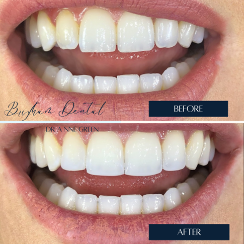 Before and after teeth whitening - Case 3